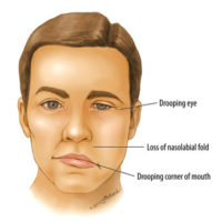 Bell’s Palsy - Neuro Kids.in